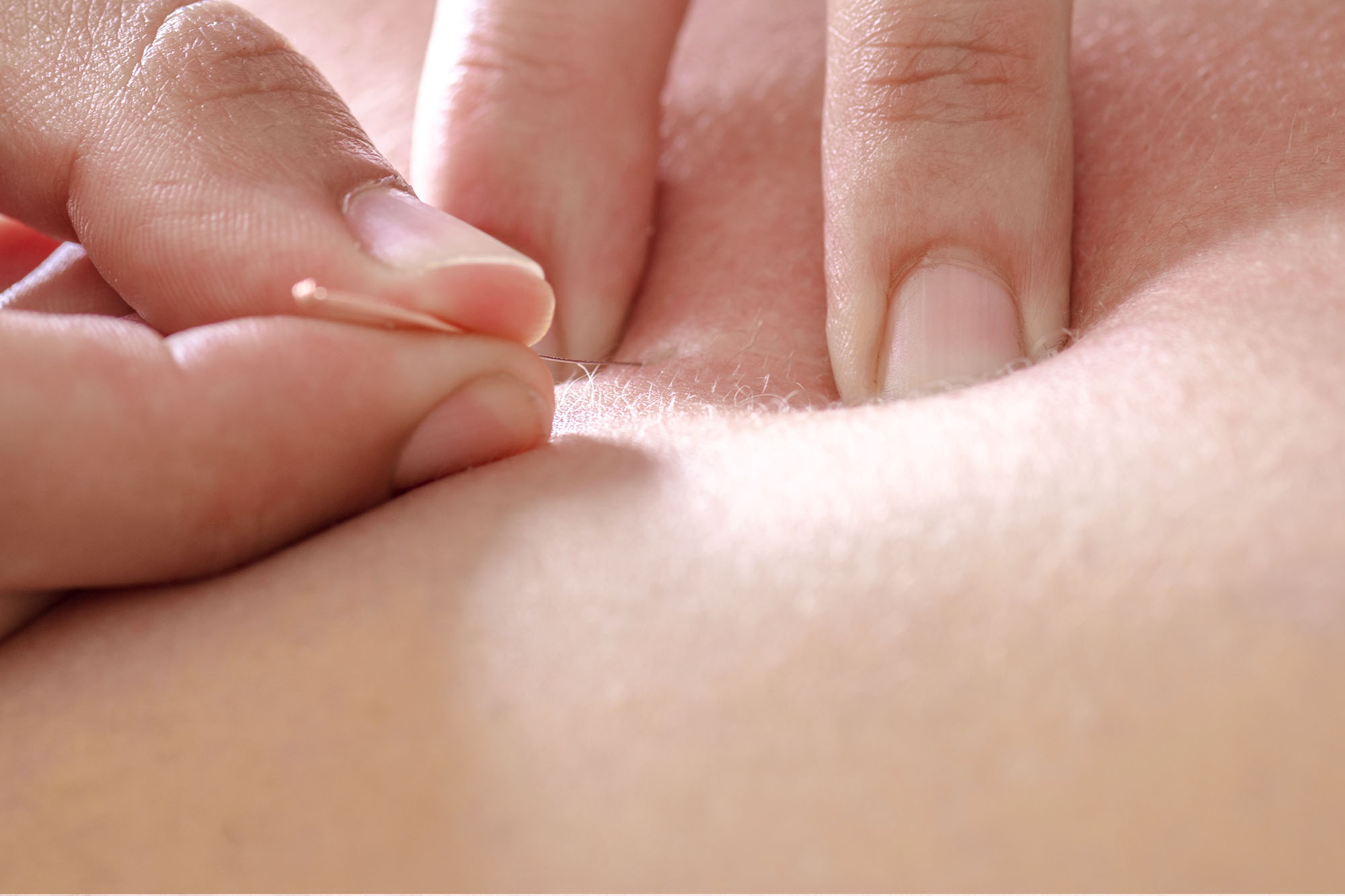 Osteopathy dry needling acupuncture